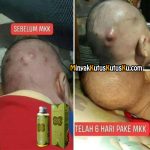 Perawatan Bisul Secara Alami Menggunakan Minyak Kutus Kutus