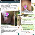 Cara Mengobati Hidrokel Pada Bayi Secara Alami